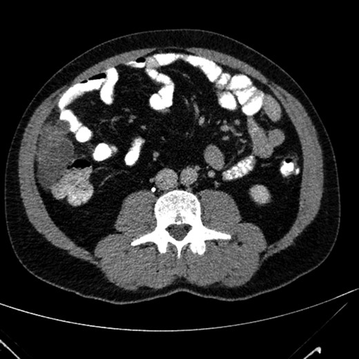 Contrast enhanced axial image that show the presence of a polylobate hypodense formation, with multiple thin internal septa.