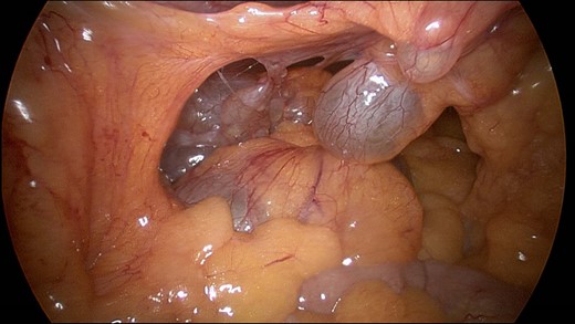 Intraoperative image showing the multicystic mass.