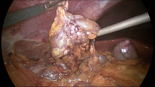 Intraoperative image showing the multicystic mass.