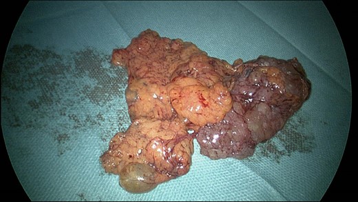 Intraoperative image showing the multicystic mass.