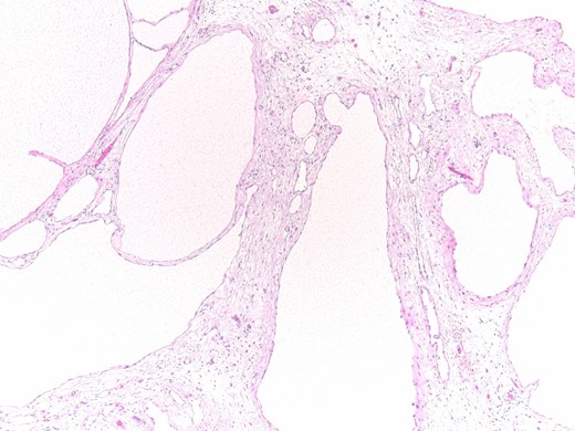 Histopathology results: cysts lined by flattened/cuboidal mesothelial cells.