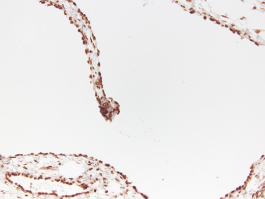 Immunohistochemically reaction for WT1.