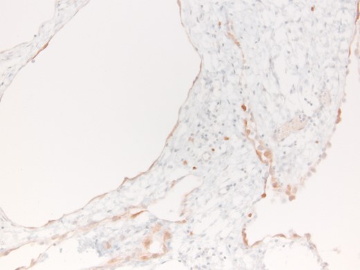 Immunohistochemically reaction for Calretinin.
