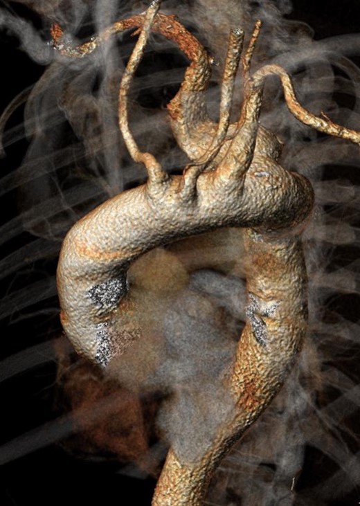 Preoperative angio-CT scan.