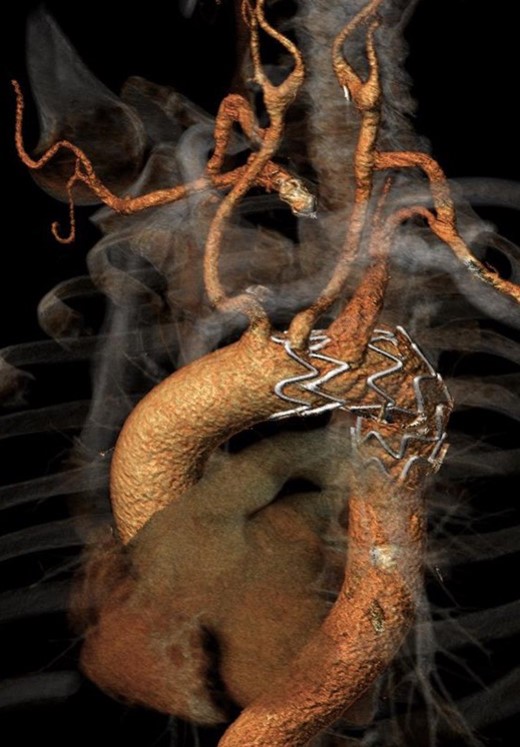 Angio-CT scan at one postoperative month.
