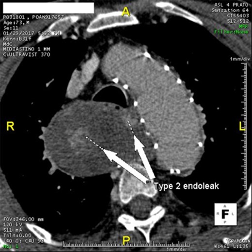 Angio-CT scan at 22 months showing Type II endoleak with significant sac enlargement.