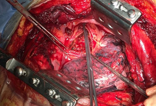 Intraoperative image showing the opened sac with the back bleeding from bronchial vessels.