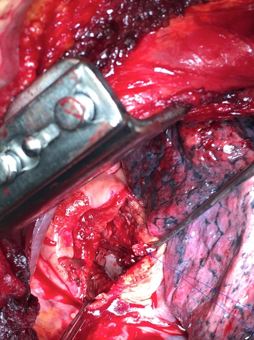 Intraoperative image after intra-sac arterial suture; the endograft is well visible on the bottom.