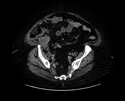Cross section of abdominal computed tomography showed an appendiceal tumor.