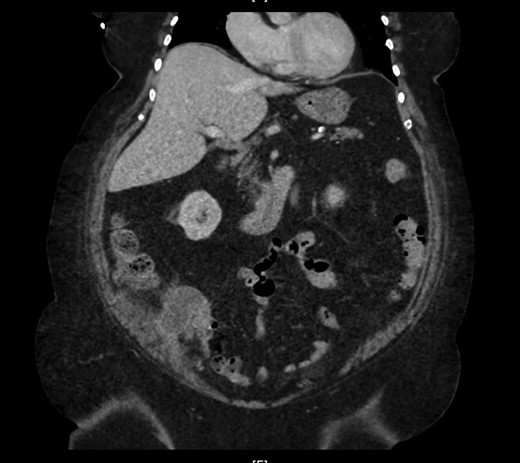 Marked appendiceal wall swelling and intraluminal filling defect of contrast medium over appendix noted in the coronal CT-image.