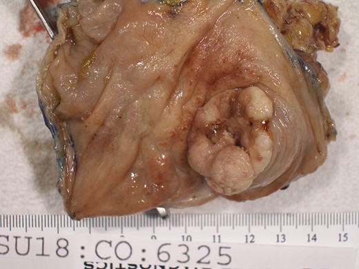 The adenoma protruding from the appendiceal orifice.