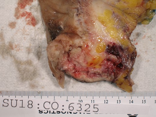 A longitudinal cross section of the appendix, adenoma at appendiceal orifice on left, hemorrhagic tip rupture on right.