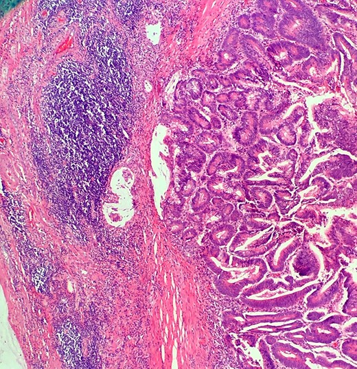 This demonstrates mucinous tumor with pushing invasion through the appendiceal wall.