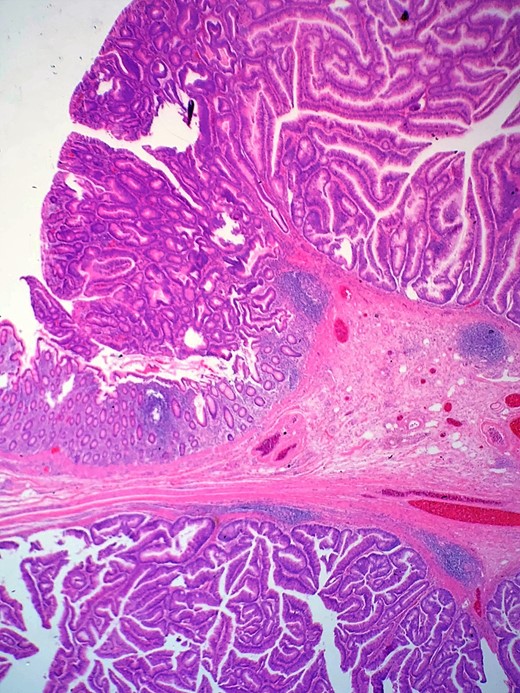 Shows transition of normal cecal mucosa to high-grade tubulovillous adenoma at the appendiceal orifice.