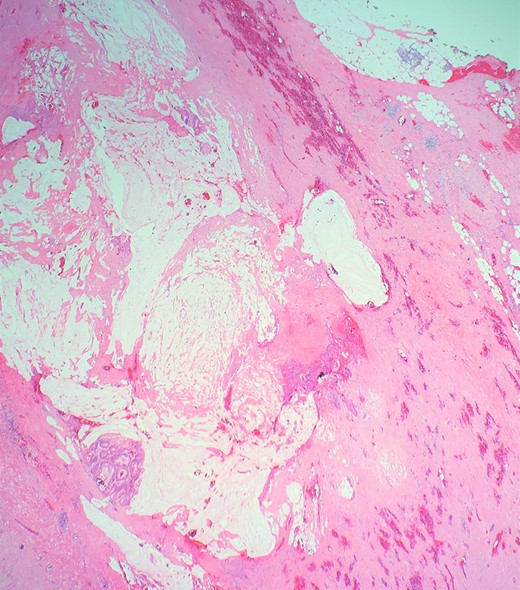 Shows cellular mucin within periappendiceal soft tissue.