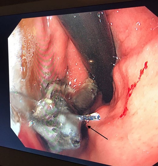 Retroflex endoscopic view of the mesh (black arrow) eroding into the stomach, 7 cm below the Gastroesophageal Junction (GEJ)-(Case 1).
