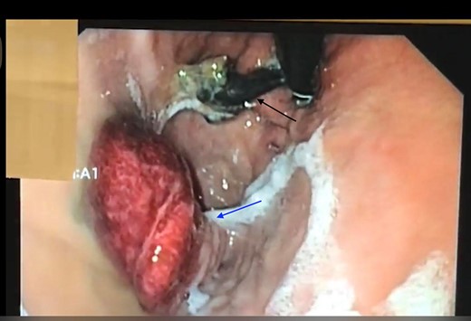Retroflex endoscopic view showing the mesh (black arrow) with an inflammatory polyp (blue arrow) mirroring it, likely due to inflammation-(Case 1).