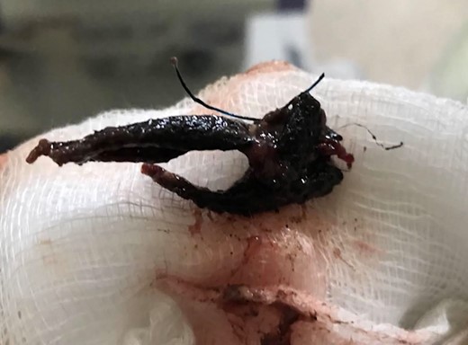 The mesh after complete removal from Case 1.