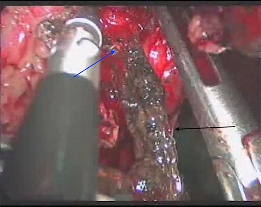 Laparoscopic view of the gastrostomy (blue arrow) and the mesh (black arrow) being removed from Case 2.