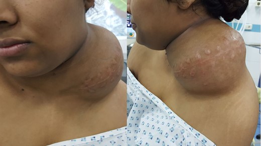 Pre-operative frontal and left-side view of the tumor.