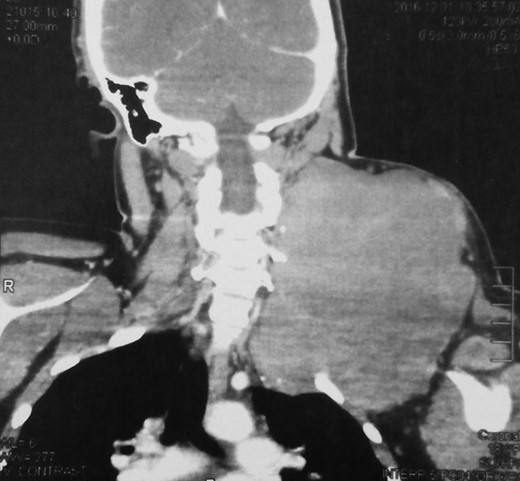 Pre-operative CT scan of the neck and shoulders.