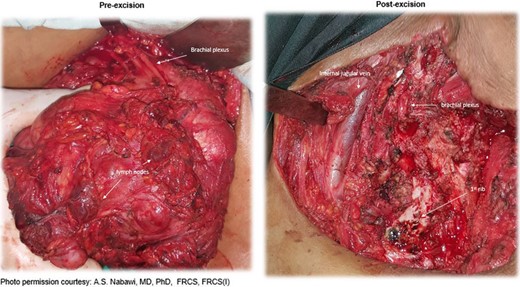 Intra-operative view: pre- and post-excision.