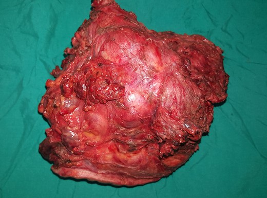 En bloc excision.