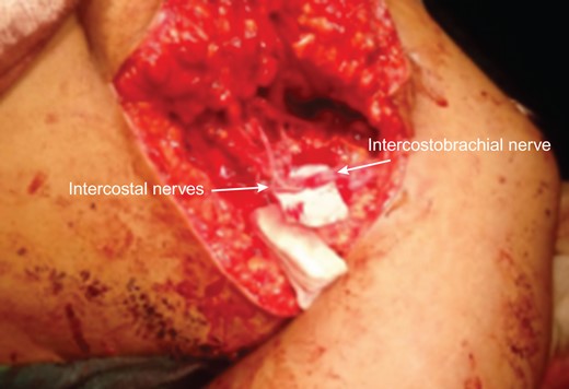 Nerve transfer—operative view.