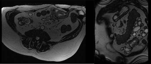 MRI enterography axial and coronal.