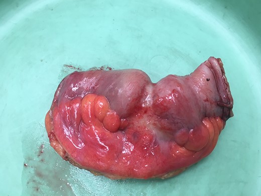 Small bowel resection.