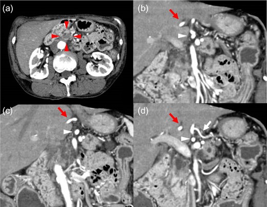 Axial and reconstructed coronal contrast-enhanced CT. (a) Axial contrast CT image showing a 17 × 12 mm hypovascular tumor in the pancreatic head (red arrowhead). No enlarged lymph nodes or distant metastases were detected. (b–d) Coronal contrast CT image showing the CHA (red arrow) forming a common trunk (white arrowhead) with the LGA (white arrow) and coursing within the lesser omentum. CHA: common hepatic artery. LGA: left gastric artery.