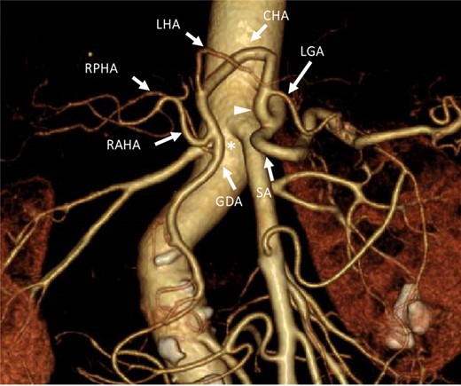 Three-dimensional computed tomography angiographic image from an anteroposterior view. The celiac artery branched into the SA. A common trunk (white arrowhead) branched into the LGA and the common hepatic artery, which arched toward the cranial side. No arterial bridge existed between the celiac trunk and the GDA (asterisk). LGA: left gastric artery. CHA: common hepatic artery. SA: splenic artery. LHA: left hepatic artery. RAHA: right anterior hepatic artery. RPHA: right posterior hepatic artery. GDA: gastroduodenal artery.