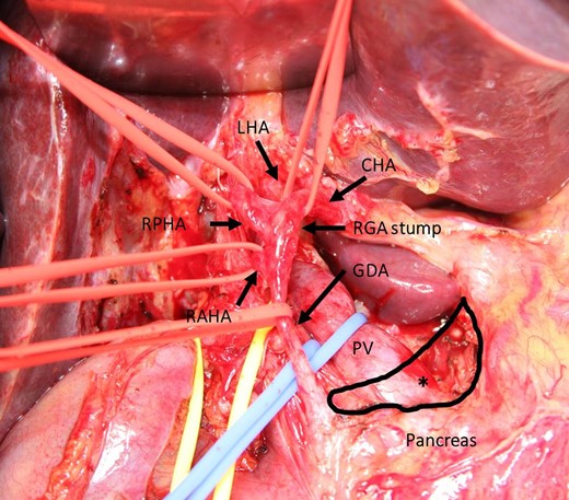 Intraoperative photograph during dissection of the hepatoduodenal ligament. The CHA arose from the lesser omentum. The RPHA, RAHA, and GDA were taped just distal to branching of the trunk. The PV was taped behind the GDA. No arterial vestige of the usual CHA was found in the supra-pancreatic area (asterisk). CHA: common hepatic artery. LHA: left hepatic artery. RAHA: right anterior hepatic artery. PHA: right posterior hepatic artery. GDA: gastroduodenal artery. PV: portal vein. RGA: right gastric artery.