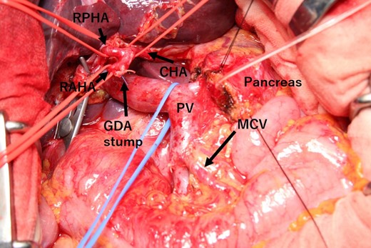 Intraoperative photograph after removal of the specimen. The CHA arose from the lesser omentum. The CHA, RPHA, and RAHA were taped, and all hepatic arteries were preserved. CHA: common hepatic artery. MCV: middle colic vein. RAHA: right anterior hepatic artery. RPHA: right posterior hepatic artery. GDA: gastroduodenal artery. PV: portal vein.