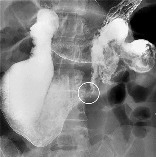 Upper GI demonstrating duodenal dilation with decompressed small bowel distal to a sharp transition point (circle).