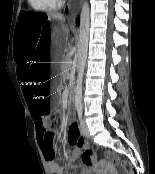 CT of the abdomen and pelvis demonstrating an acutely angulated SMA with compression of the duodenum between the SMA and the aorta.