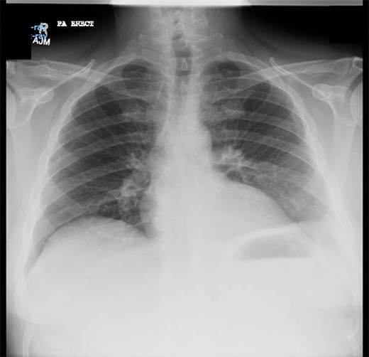 Chest X-ray prior to transgastric drainage. Suggestive of Left pleural effusion/ lower lobe collapse.