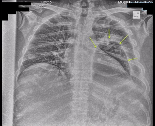 Chest X-ray post-transgastric drainage. Area of residual space highlighted with arrows.