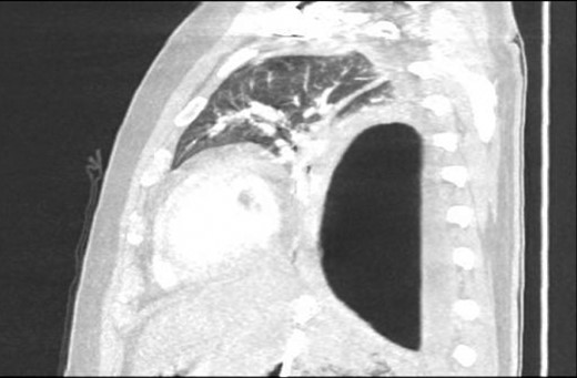 Sagittal view CT Chest revealing large residual space with loss of left lung volume due to the pseudocyst. Image post-transgastric drainage.