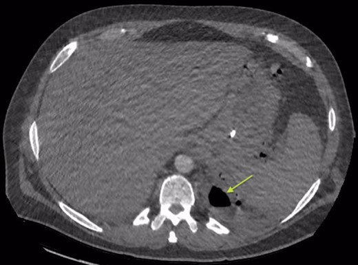 Area of communication between the drained Pseudocyst and the Left Pleura. Space noted with arrow.