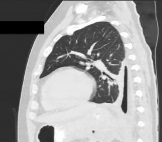 Sagittal view CT Chest post-intercostal catheter drainage of the Pancreatico-pleural fistula. Smaller residual space can be noted compared to Image 3, with some ongoing loss of lung volume and small fluid collection.