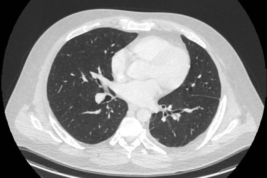 CT one month post-decortication with complete re-expansion of the left lung and minor post-operative changes noted posteriorly.