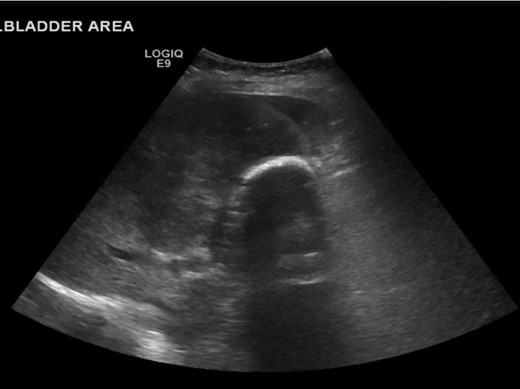 US showing porcelain gallbladder with a posterior acoustic shadow.