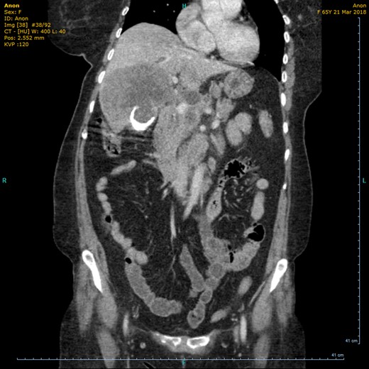 CT (coronal view) showing circumferential calcification in the thickened wall of the gallbladder.