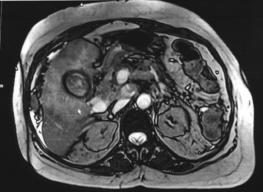 MRCP shows gallbladder fundus with a T2 weighted hypo intense rim.