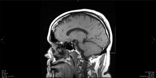 Initial preoperative MRI, sagittal cut.