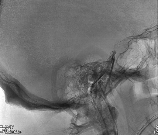 Bilateral inferior petrosal sinus sampling.