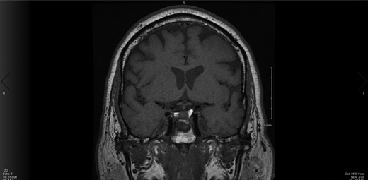 postoperative MRI, coronal cut.
