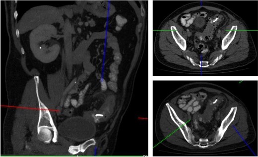 CT imaging identified a small curvilinear metallic foreign body within the sigmoid colon.