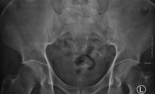PFA showed the persistent presence of a metallic foreign body over the sigmoid colon.